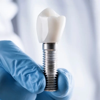 Dental Implants vs. Bridges: Which Option is Right for You?
