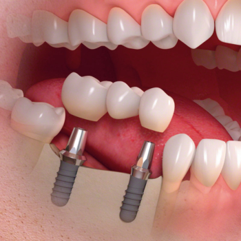 Implant-Supported Dentures: A Game-Changer in Restorative Dentistry