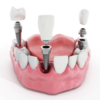 Smile Confidently: How Dental Implants Improve Quality of Life?