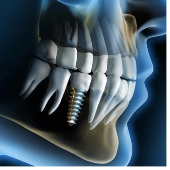 Average cost of dental implants in turkey