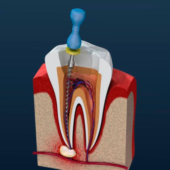 Choosing the Right Dental Crown: Materials, Types, and Uses