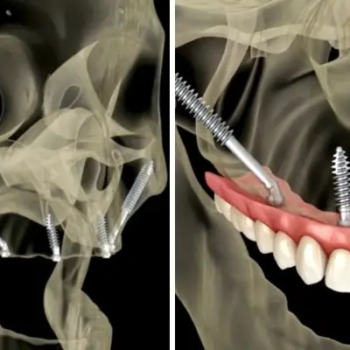 zygomatic-implants-turkey