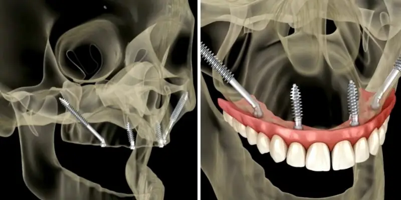 zygomatic-implants-turkey