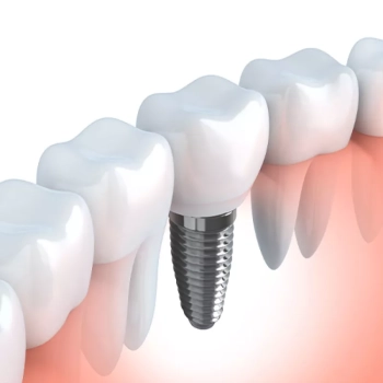 Full mouth dental implants Turkey price