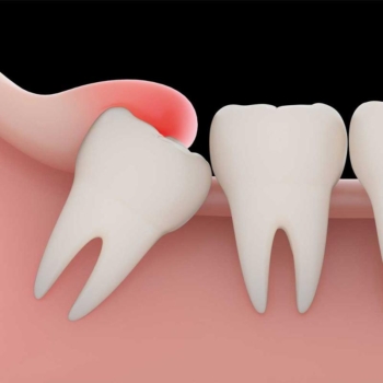 Horizontal bone augmentation