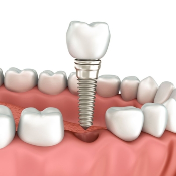 Can you get turkey teeth with missing teeth?