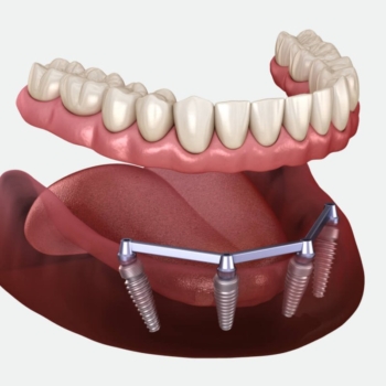 3 on 6 Dental Implants: Revolutionizing Full Mouth Rehabilitation