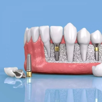 Exploring Mini Dental Implants: Small Size, Big Impact