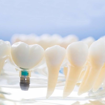 What is permanent teeth fixing cost?