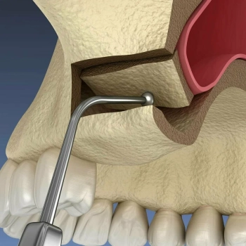 Sinus lift before dental implant