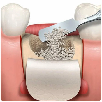 Symptoms of failed sinus lift