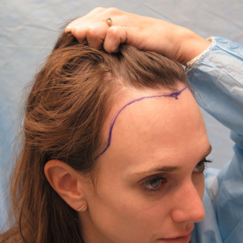 Hair Transplant for Women: Is It Possible and How Successful Is It?