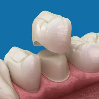 How often should dental crowns be replaced?