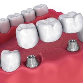 What is bone augmentation in implant dentistry?