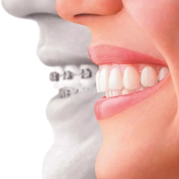 Fix teeth alignment without braces