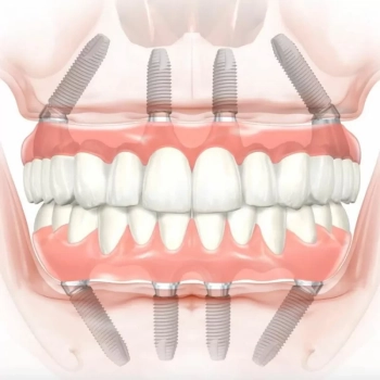 Zygomatic Implants in Turkey