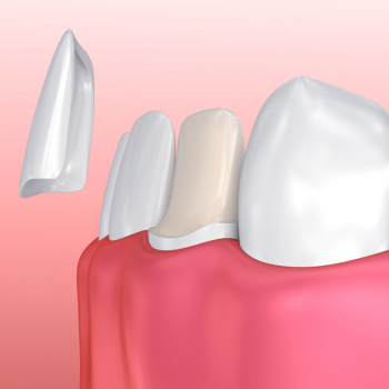 Dental veneers Antalya