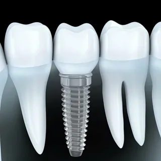 How long do dental implants take in Antalya?