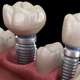 Full mouth dental implants Turkey package deals