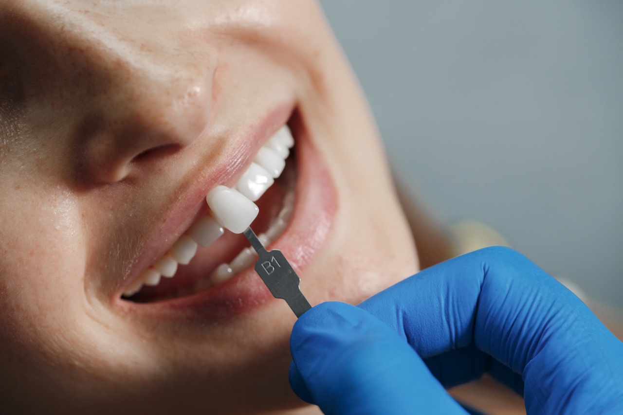 porcelain-veneers
