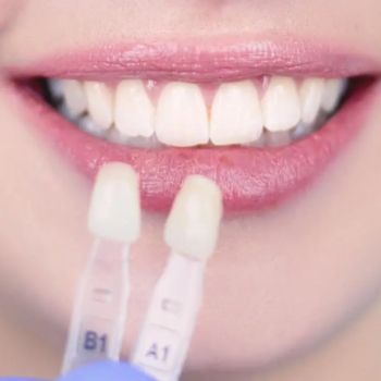 dental-veneers-for-missing-teeth
