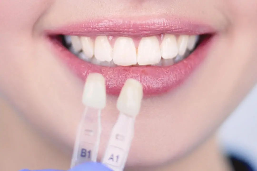 dental-veneers-for-missing-teeth